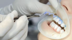 wybielanie zębów w gabinecie stomatologicznym warszawa