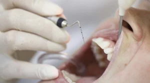 kiretaż zamknięty, leczenie periodontologiczne