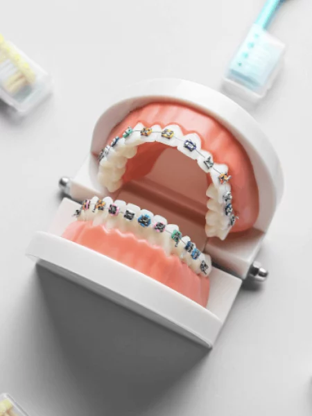 aparat-ortodontyczny-staly-metalowy