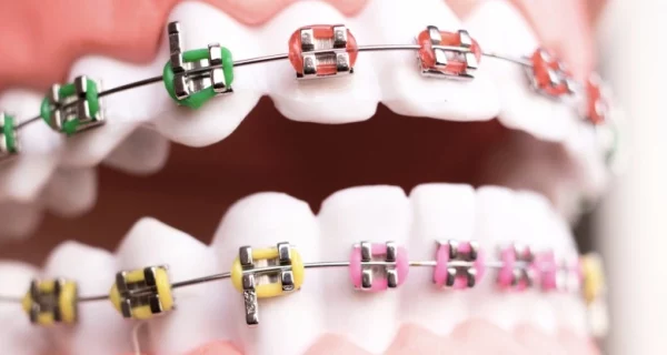 aparat ortodontyczny stały metalowy, Rodzaje aparatów ortodontycznych
